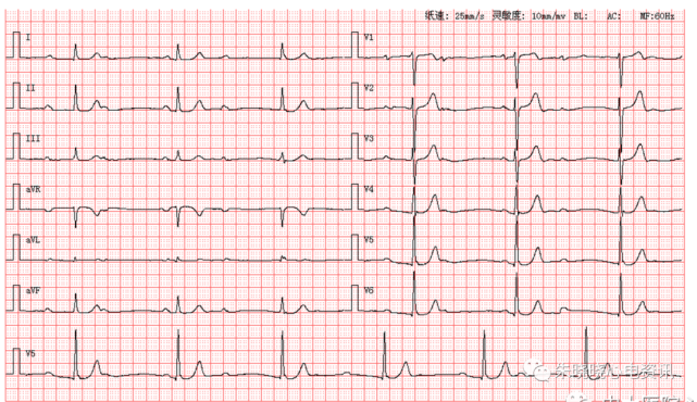 每日读图第1676期房性早搏二联律