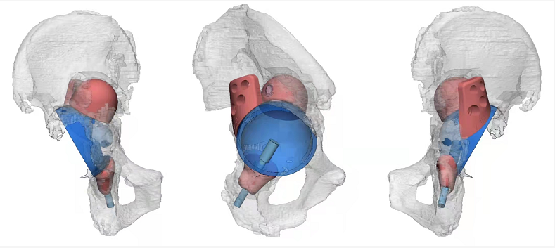 3d打印量身定製大理州人工關節置換術再升級