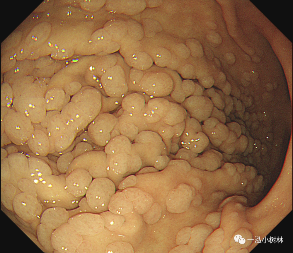 1%),腺瘤周围胃黏膜发生胃癌风险是