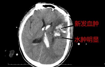 复查头部ct示:术区新发出血(王先生本身血管质量差导致),且脑水肿较之