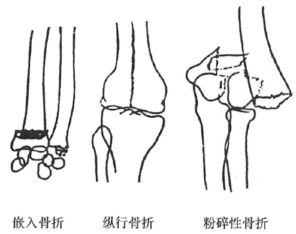 四肢骨折的分型丨上肢骨折及脫位