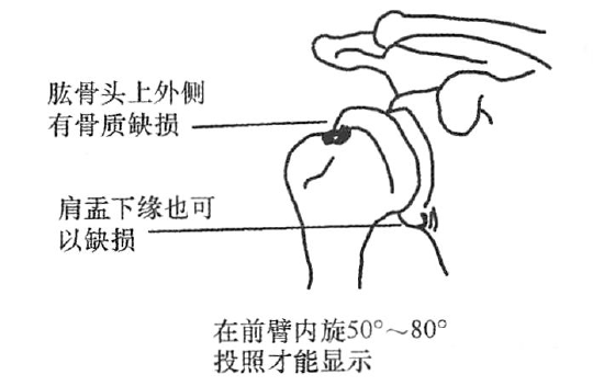 a,i型,大結節骨折肱骨頭下移;肱骨大結節骨折合併肩關節脫位右肱骨頭