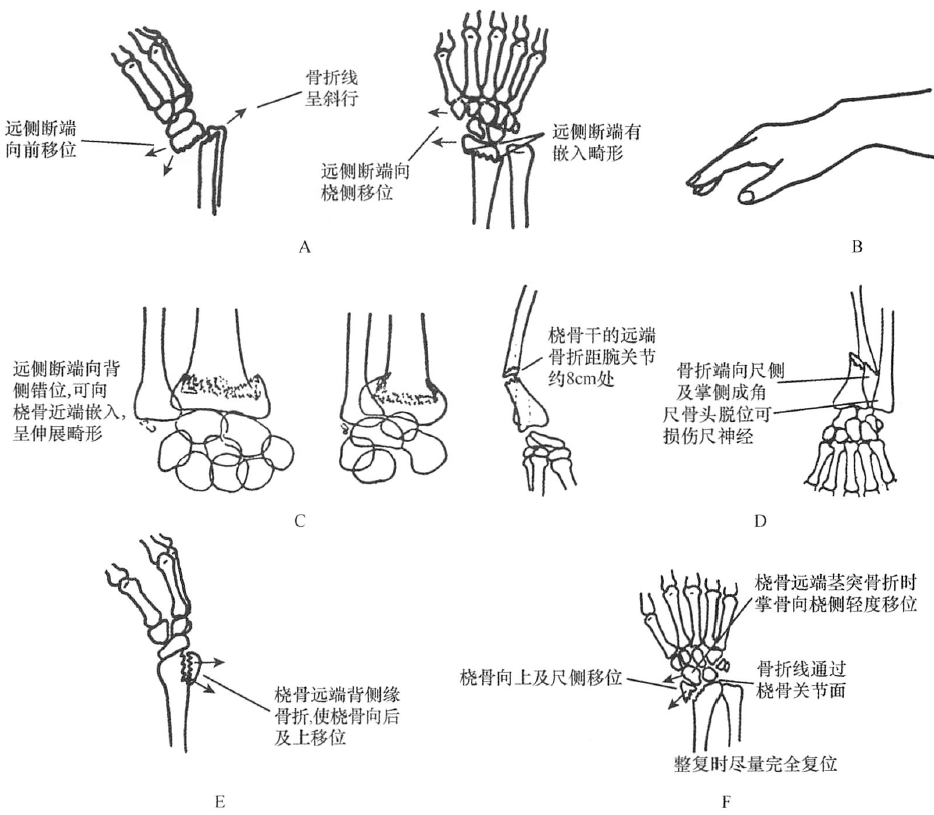 四肢骨折的分型丨上肢骨折及脱位