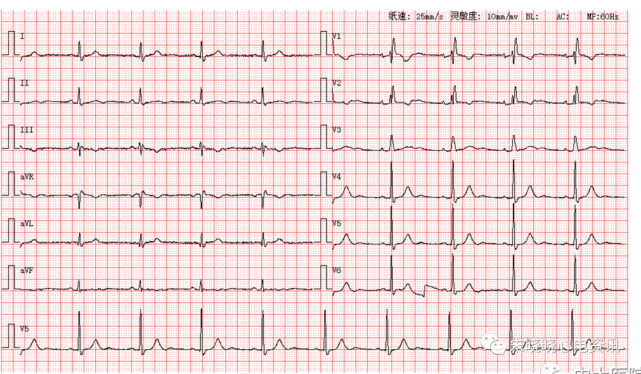 患者女,53歲,圖為其正常體檢心電圖第1678期讀圖解析來源於中大醫院心