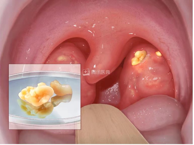 扁桃体结石当扁桃体慢性炎症导致扁桃体隐窝堵塞时,脱落的黏膜上皮