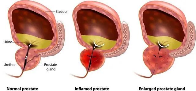 并导致精囊炎,睾丸炎,膀胱炎,男性功能障碍和不育症,甚至发展为慢性
