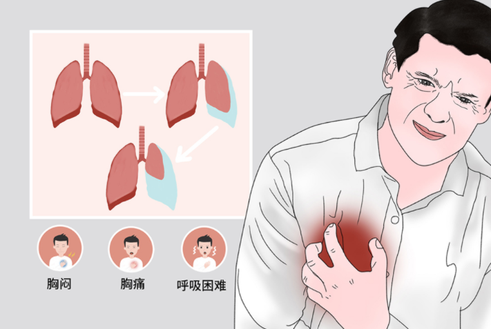 瘦高大帅哥运动后突发胸痛胸闷检查发现肺破了