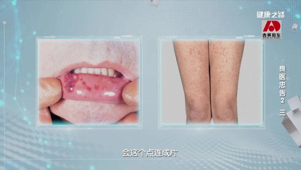 白血病人多数会出现皮肤有出血点.