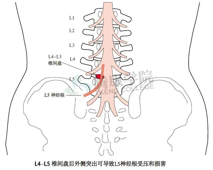 在患者存在l4~l5或l5~s1椎间盘突出因而导致l5或s1神经根受压迫时