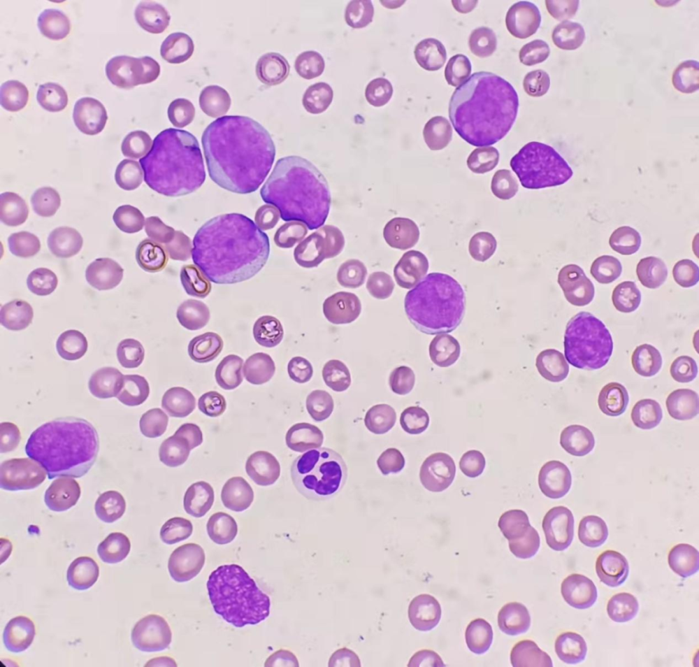 可见两个淋巴细胞,多个原始细胞,其中两个存在胞核内陷(杯口细胞)外周