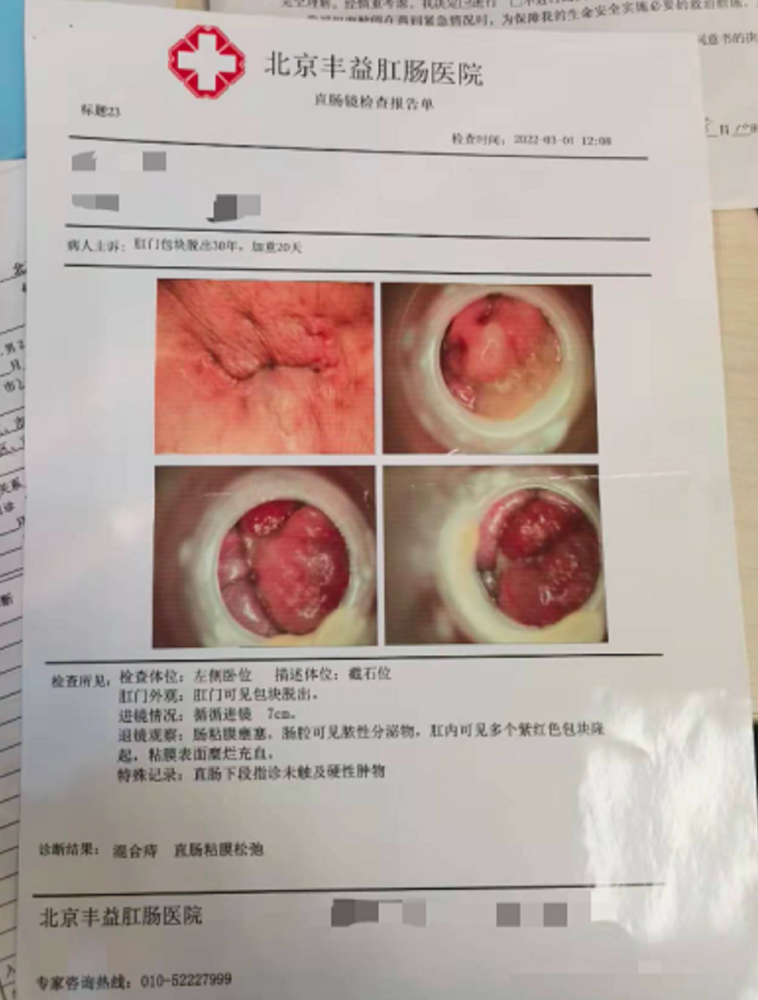 直肠检查诊断:肛门可见包块脱出 肠粘膜壅塞 直肠粘膜松弛1)直肠镜