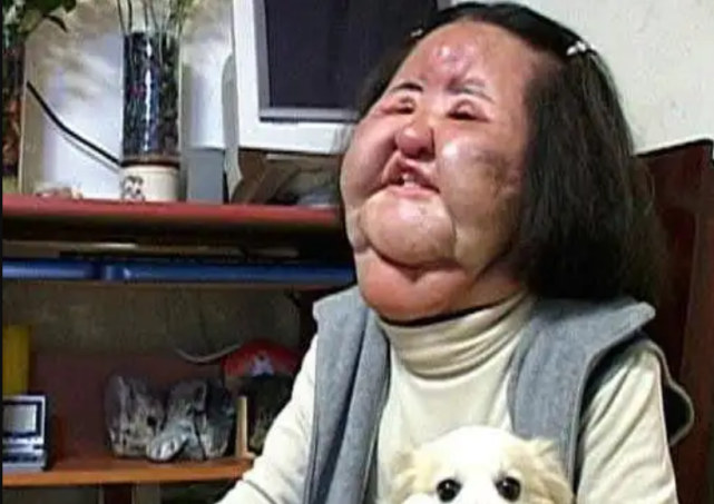 女星韩慧景迷恋整容精神失常给脸注射沙拉油结果肿成猪头