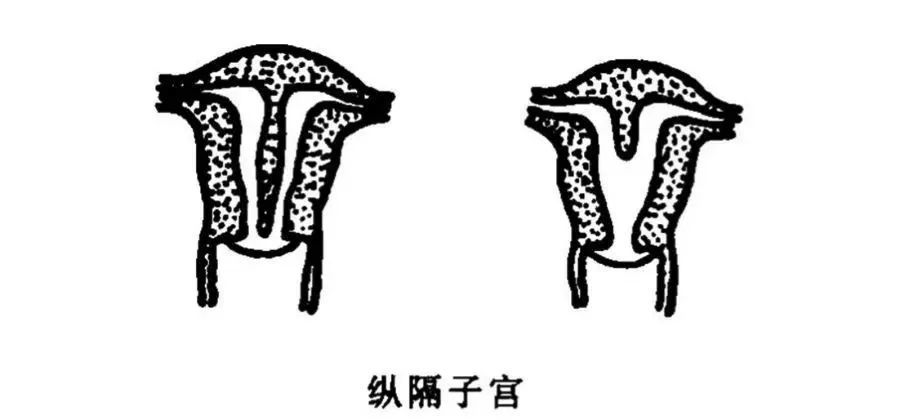 使双侧管腔融合不全或融合后的纵隔未被完全吸收而导致先天性单角子宫