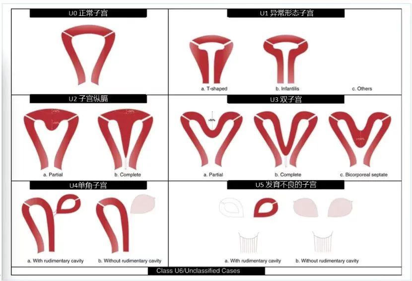 每周一课第9期精彩分享马德美教授子宫纵隔的诊治策略