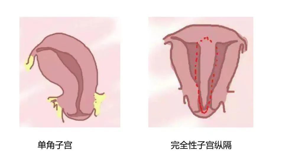 每週一課第9期精彩分享馬德美教授子宮縱隔的診治策略