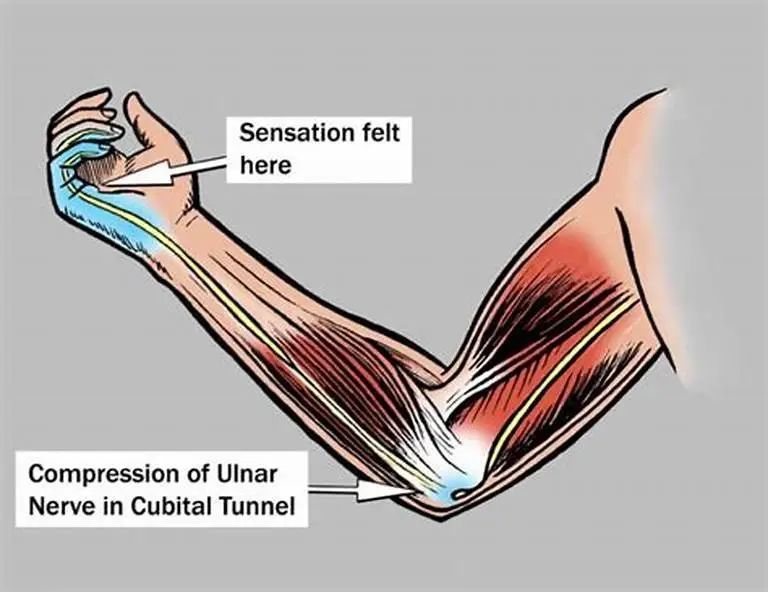 What Can Mimic Ulnar Nerve Entrapment