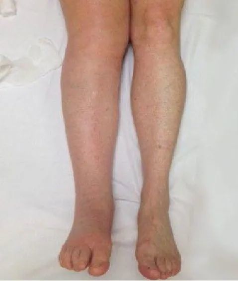 当液体在体内组织间隙呈弥漫性分布时呈全身性水肿;液体积聚在局部