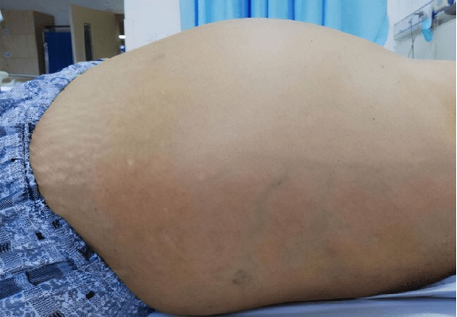 全身水肿:心源性水肿,肝源性水肿,肾源性水肿,内分泌性水肿等下肢