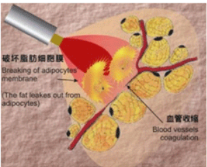 就是通過使用有助於脂肪代謝的成分所搭配而成的藥品注射到皮下脂肪