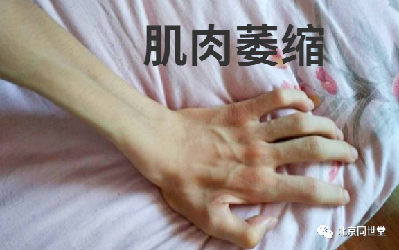 肌肉萎缩最明显,比较容易发现的地方是手上,尤其是虎口,大小鱼际,手指