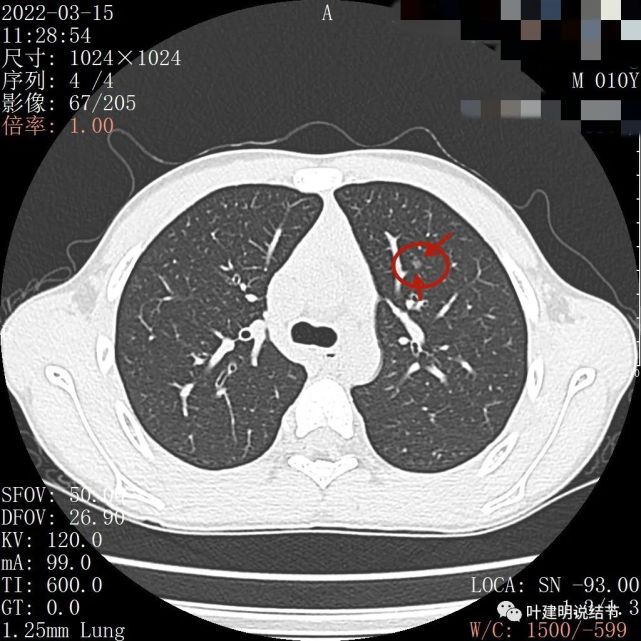 予以複查胸部ct,下面是重點部位的截圖:左下葉另處小斑片狀磨玻璃影