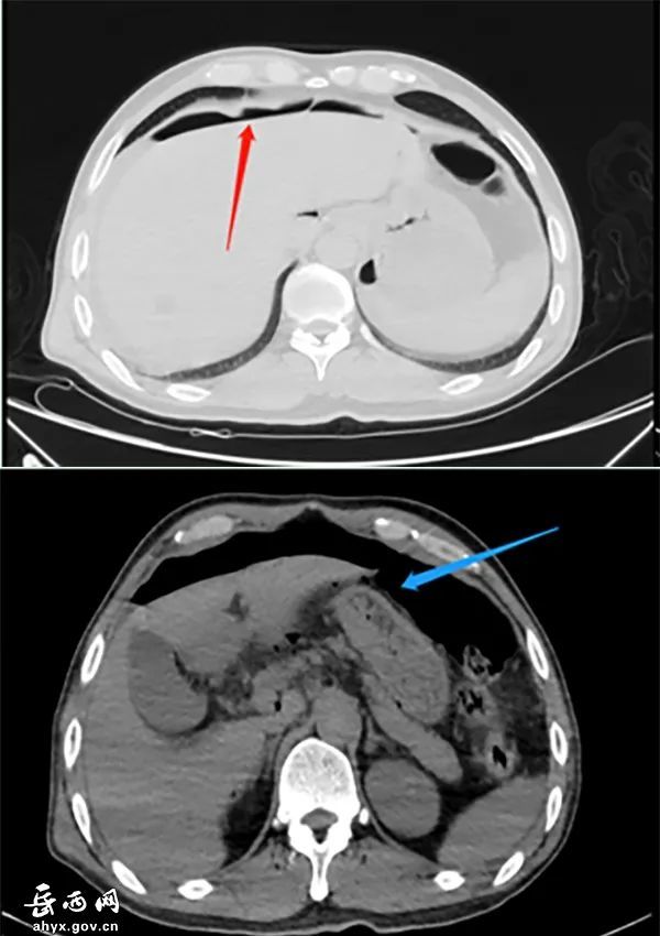 县医院成功抢救胃溃疡巨大穿孔患者生命