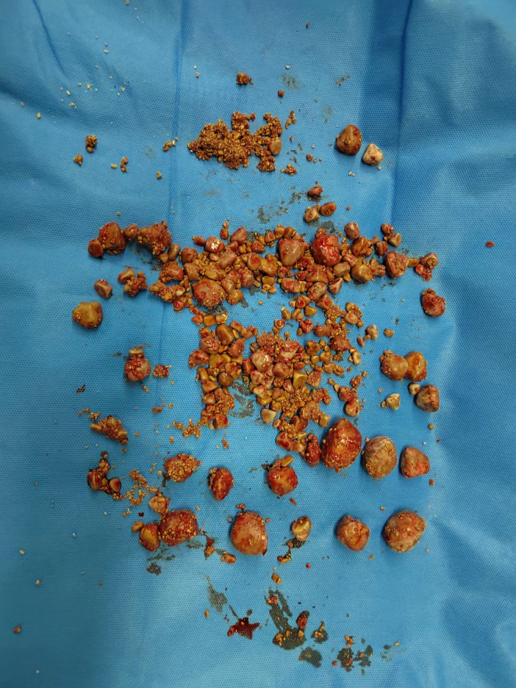 新版"石头记"——延安市人民医院泌尿外科成功取出百余枚结石,还患者