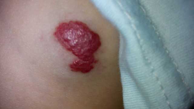 宝宝身上出现这种斑块要当心可能导致血管畸形