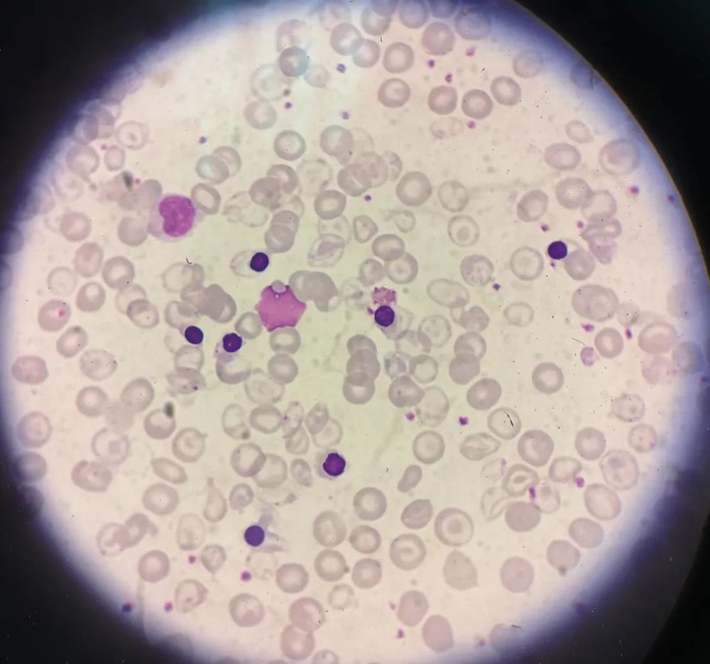 一例重型β地中海贫血患者外周血有核红细胞异常增多_腾讯新闻