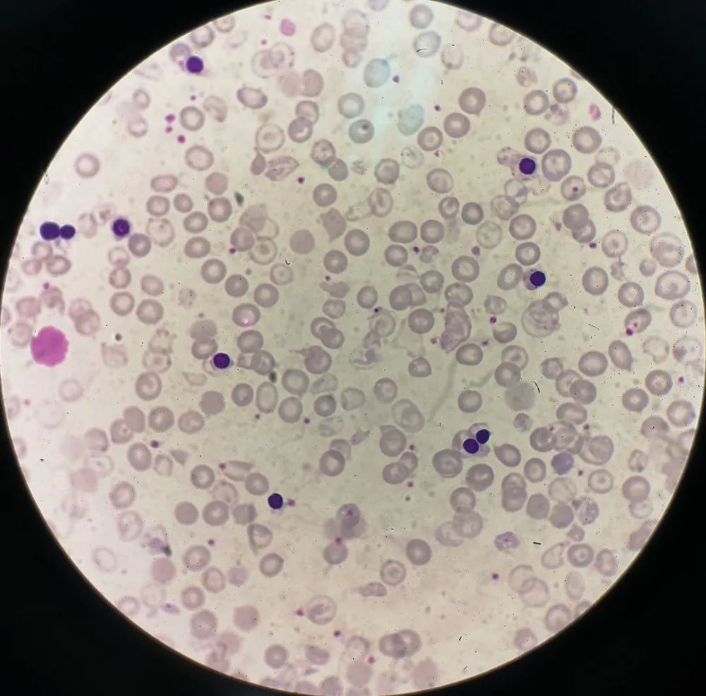 一例重型β地中海贫血患者外周血有核红细胞异常增多_腾讯新闻