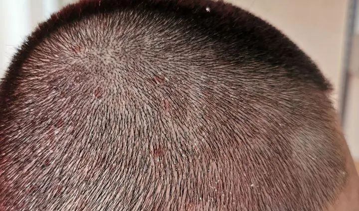 如何判断是不是脂溢性皮炎(如何判断是不是脂溢性皮炎脱发)