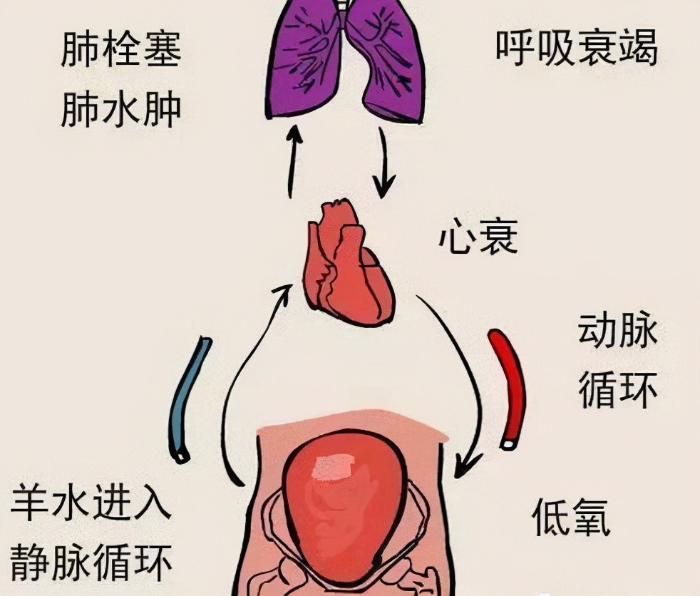 剖宫产和顺产相比哪种分娩方式更容易发生羊水栓塞孕妇要知道