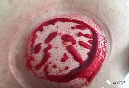 刺血疗法(绝对干货)