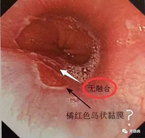 胃食管反流30個問題超全大彙總