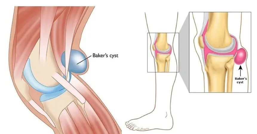 膕窩囊腫又叫bakers囊腫,是腓腸肌內側頭的滑膜囊腫.