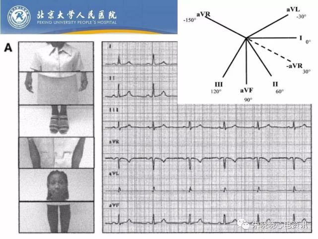 12導聯心電圖曾被稱為