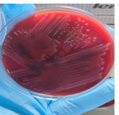 流产妇感染b族β溶血链球菌1例