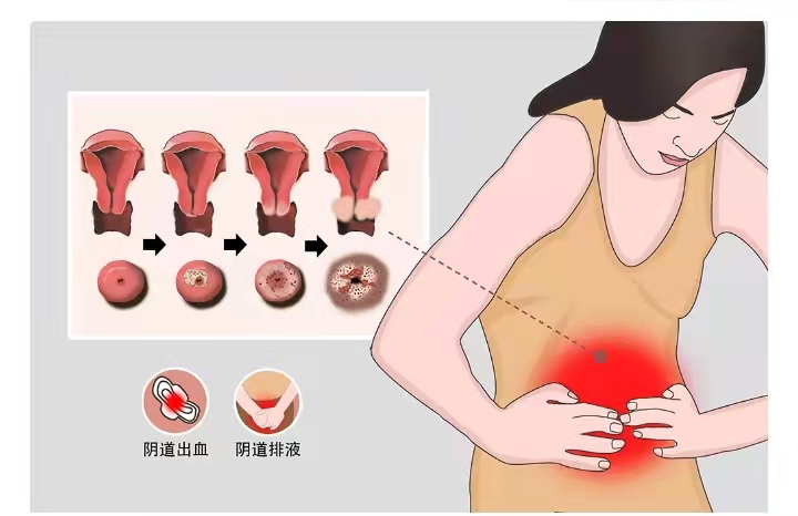 健康宾川宫颈癌的防治知识您了解多少