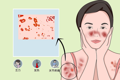 走進紅斑狼瘡瞭解病因預防和治療