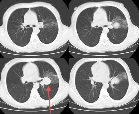 肺活检病理提示肺癌手术切下来却是良性肿瘤这误诊么