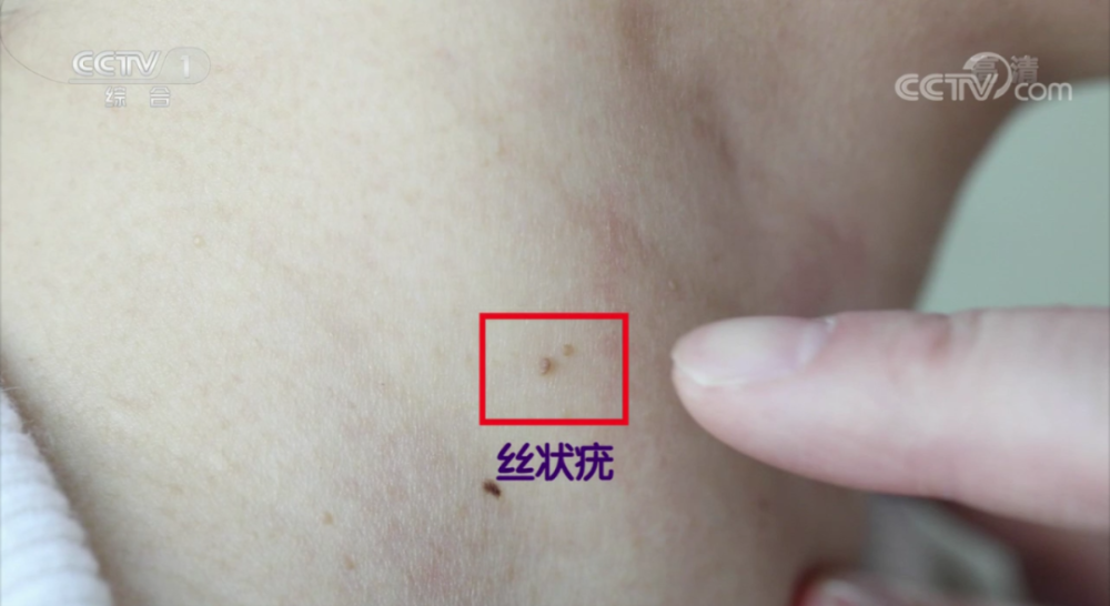 身上长的"小肉揪揪"预示感染了hpv病毒?专家解答来了_腾讯新闻