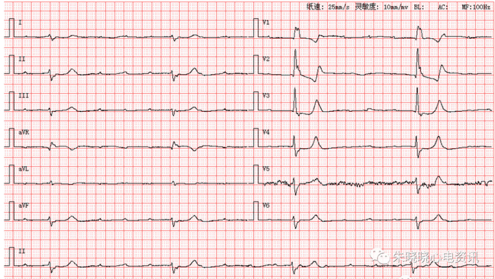 每日读图|第1684期 高度房室传导阻滞 交界性逸博心律_腾讯新闻