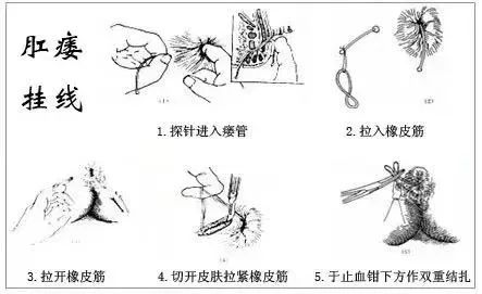挂线疗法是一种在肛瘘的内口和外口之间挂线(橡皮筋或有腐蚀性的药线)