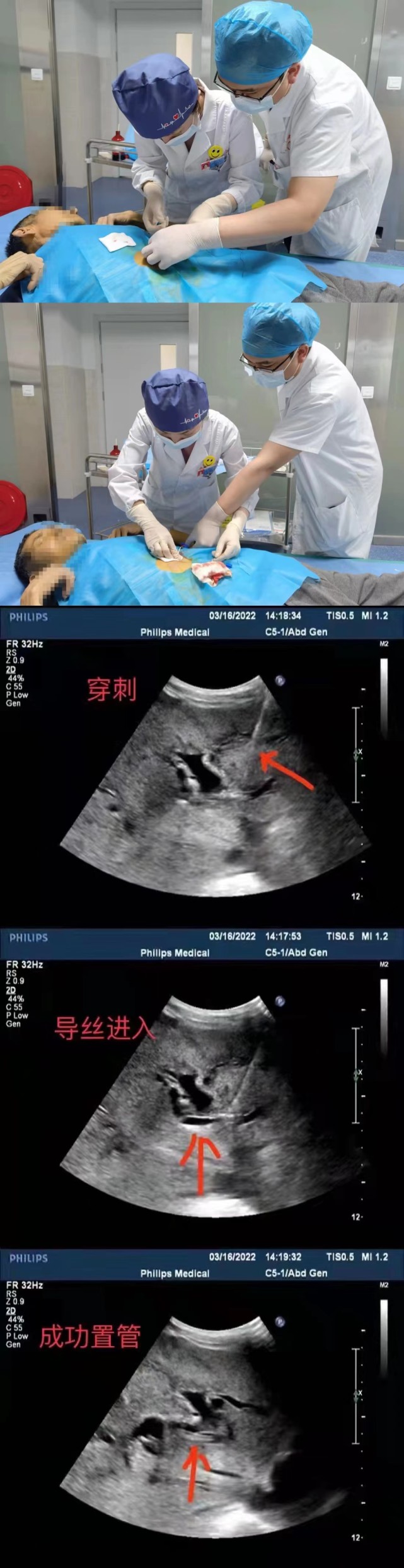 湘西州民族中医院成功完成该院首例超声引导下经皮肝胆管穿刺置管引流