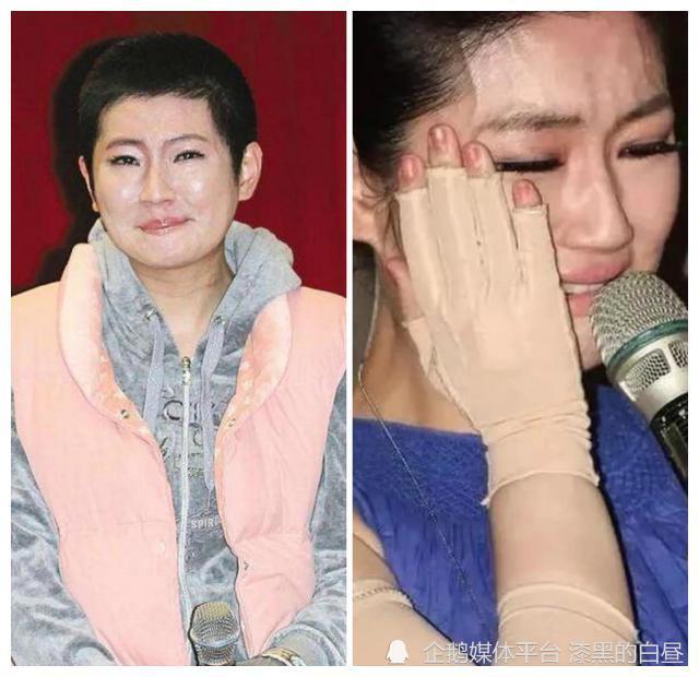 后来因为拍摄时爆破失误,导致俞灏明和任家萱纷纷被烧伤,任家萱全身有