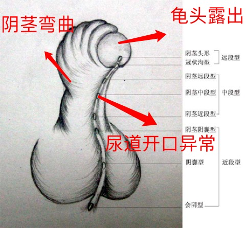 它的典型特點有:陰莖下彎;尿道開口沒有開到正位;背側的包皮呈帽狀