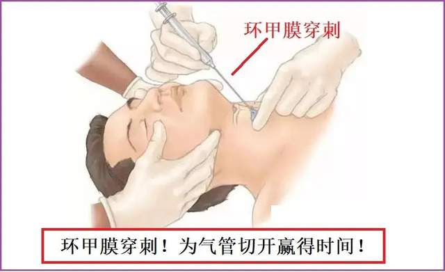 孩子可能已经开始烦躁的情况下,要来做气管切开和环甲膜穿刺都是很有