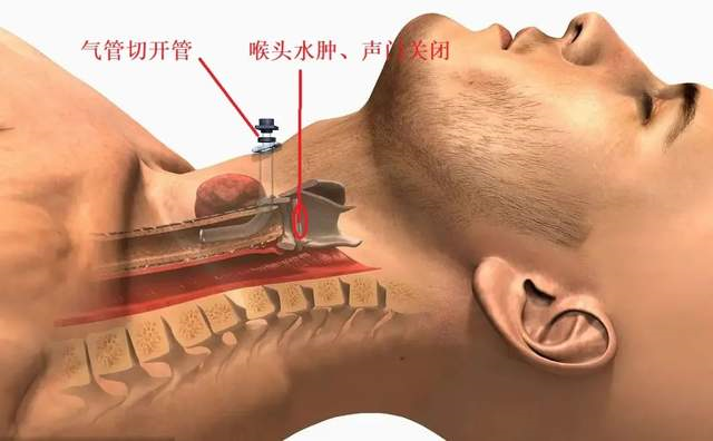 因为小儿发生喉头水肿的时候,我们从口腔放管进去是没办法通过喉头的
