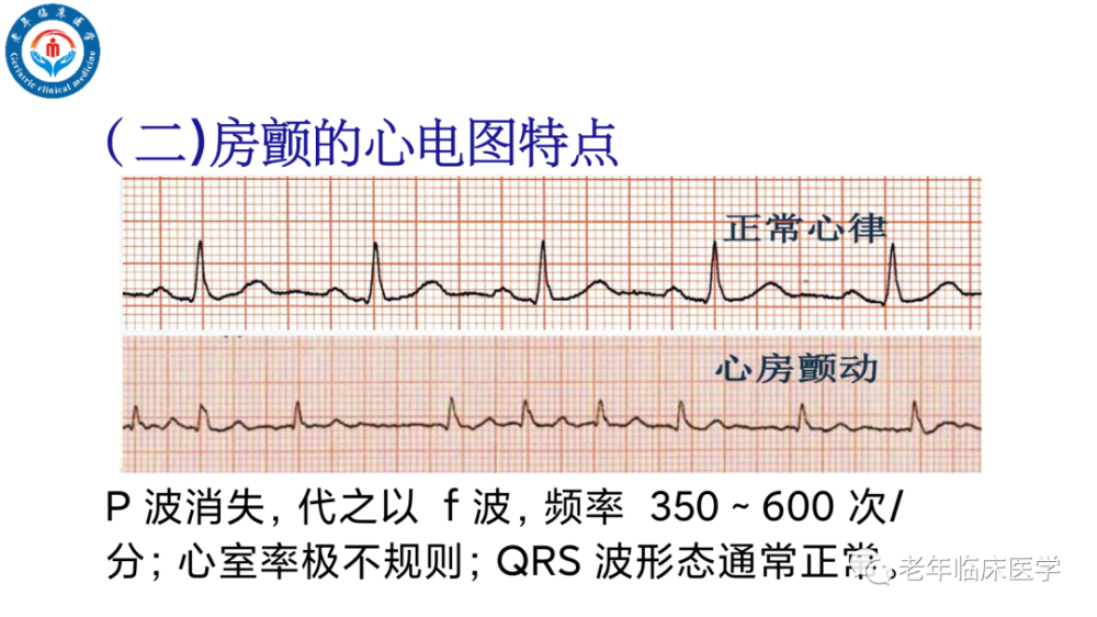 指南认为应针对房颤高危人群开展筛查,包括高龄,心衰,肥胖,高血压