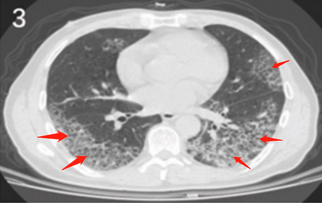 ggo伴節段性肺實變徵象5:雙肺瀰漫性磨玻璃陰影伴支氣管充氣徵徵象6